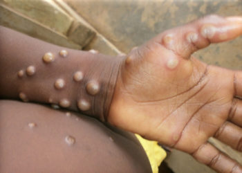 Мавпячу віспу виявили вже у Чехії та Словенії