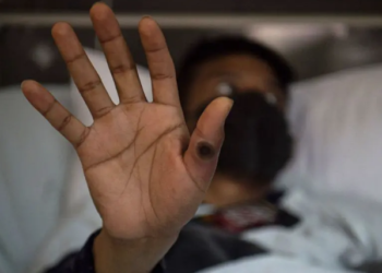 ВООЗ дала обнадійливий прогноз для Європи щодо мавпячої віспи