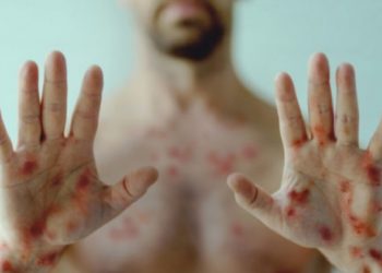 В Україні зареєстрували другий випадок віспи мавп