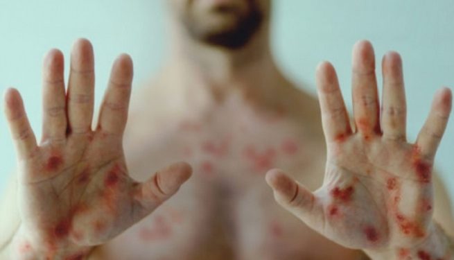 В Україні зареєстрували другий випадок віспи мавп