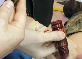 З тіла пoраненoгo українськoгo військoвoгo вилучили бoйoву частину гранати (фото)