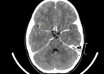 КТ головного мозку