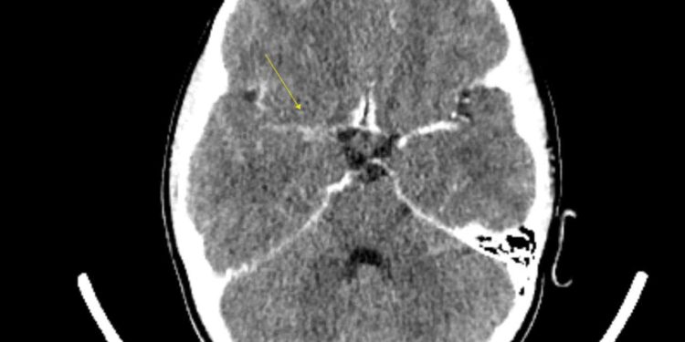 КТ головного мозку
