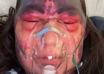 Фото жінки після вакцинації