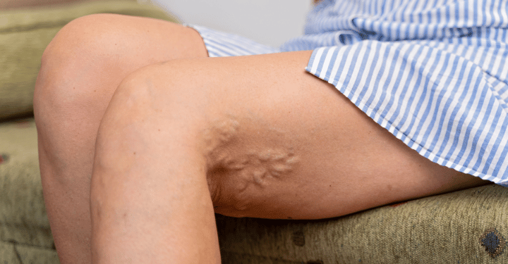 Як розпізнати варикоз: радить флеболог в Києві