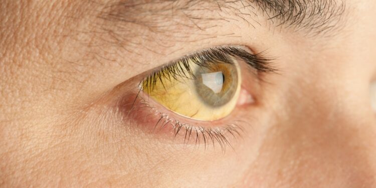 Медики фіксують зростання випадків гепатиту А